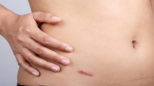 阑尾炎术后会留疤吗 阑尾炎术后影响留疤的因素都有哪些