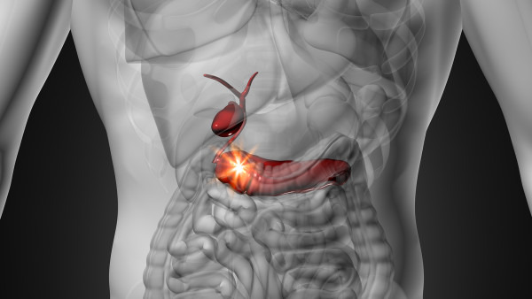 多发性胆囊息肉癌变吗，多发性胆囊息肉病因、治疗及癌变率