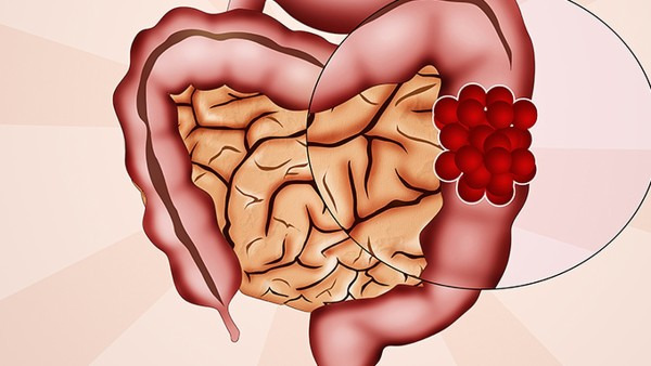 腸梗阻能喝水嗎 腸梗阻該怎樣治療