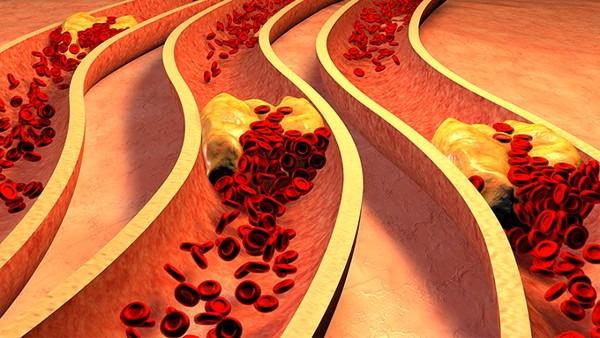 血管瘤是先天性的吗，血管瘤形成原因是什么？
