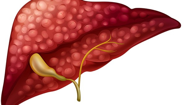 得了肝血管瘤怎么办 肝血管瘤的最佳治疗方法都有哪些