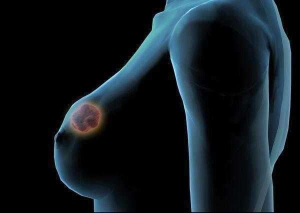 乳房肿块伴压痛可能是哪些疾病？看完你就知道了