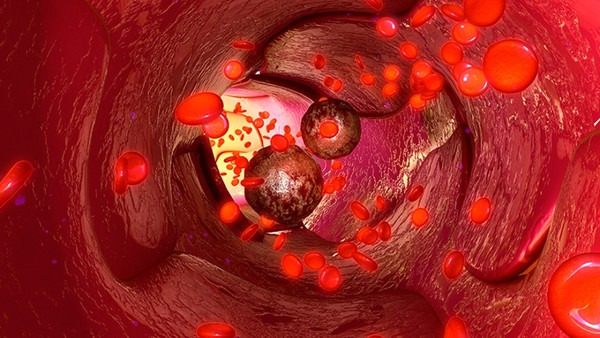 血管瘤是怎么形成的？可能是这5个原因造成的