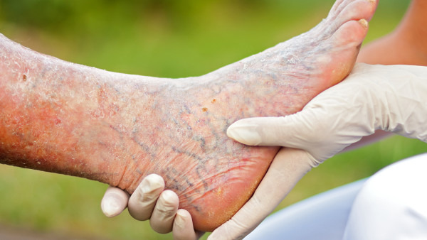 脚面血管瘤是怎么回事？有这些病因