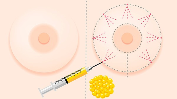 乳頭疼是怎么回事，乳頭疼要怎么護理？