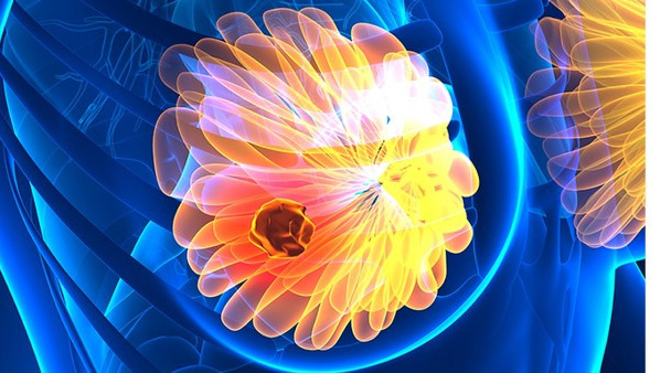 乳腺纤维瘤三级严重吗，纤维瘤哪些人群更容易癌变？