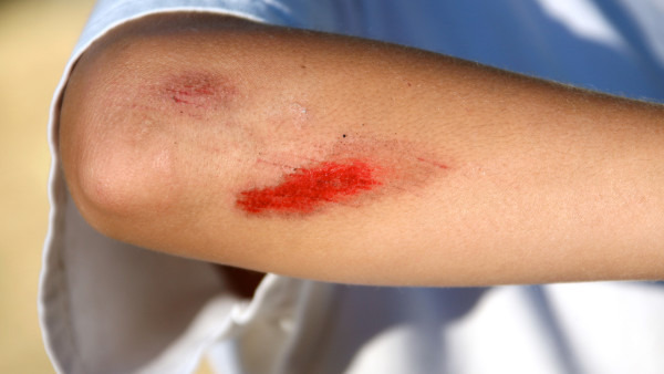 伤口结痂厚说明说明受伤的程度比较严重，而且出血量比较多