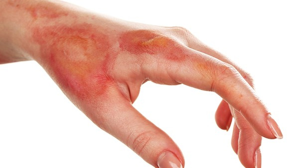 被热油烫伤可以用凉水冲洗伤口或者用凉水侵泡