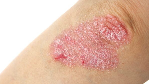 牛皮癣的3个主要特征