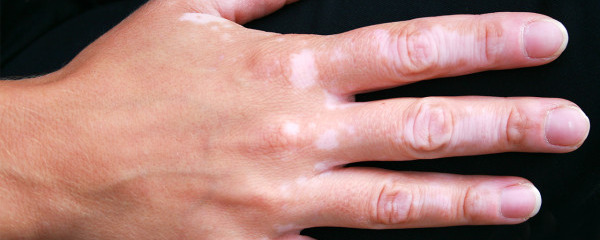 皮肤上有白斑点是怎么回事 多半是这6种疾病引起的