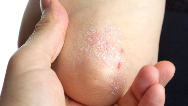 牛皮癣和银屑病是一样的吗？同一疾病