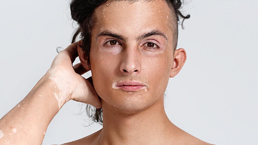 白癜风移植对年龄有限制吗 常见的3种白癜风移植术