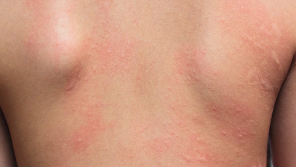 荨麻疹不治疗会怎样，荨麻疹的4个危害，严重可致命