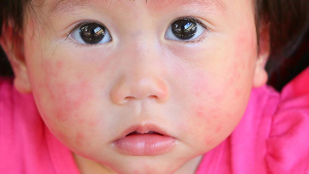 小儿荨麻疹的治疗方法，治疗小儿荨麻疹的3个手段