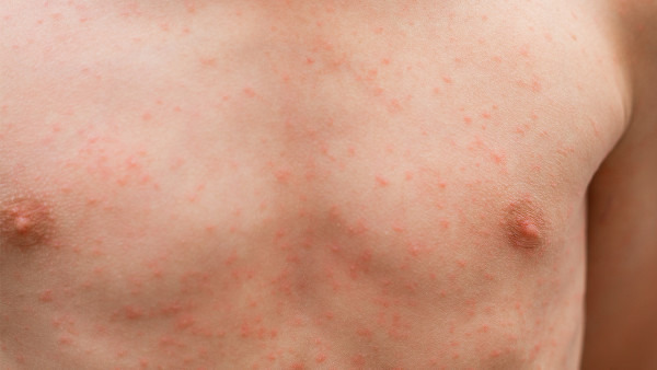 夏季为什么容易得湿疹 导致皮肤湿疹3个因素
