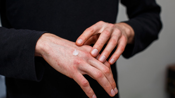 过敏性湿疹怎么治疗可以痊愈 湿疹多长时间能治好