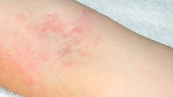 湿疹对身体有哪些危害 湿疹会造成的3个害处
