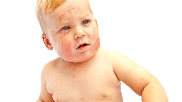 宝宝长湿疹跟什么有关 注意这3大因素