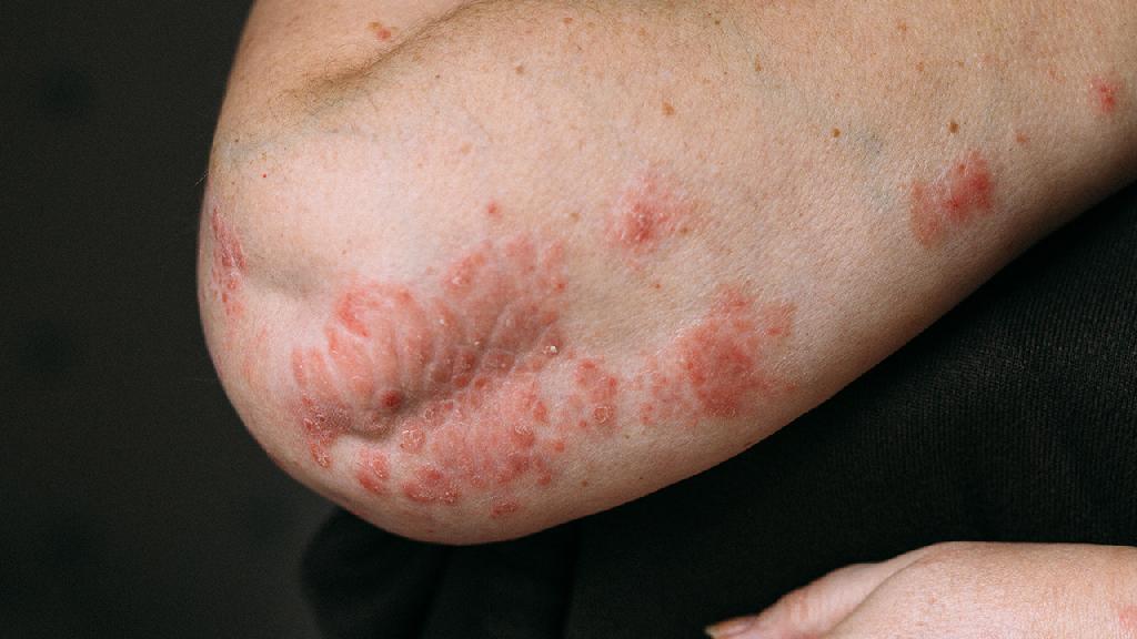 湿疹都有哪些症状图片图片