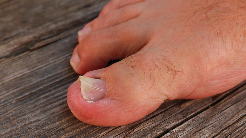 灰指甲有什么症状 灰指甲的3大症状