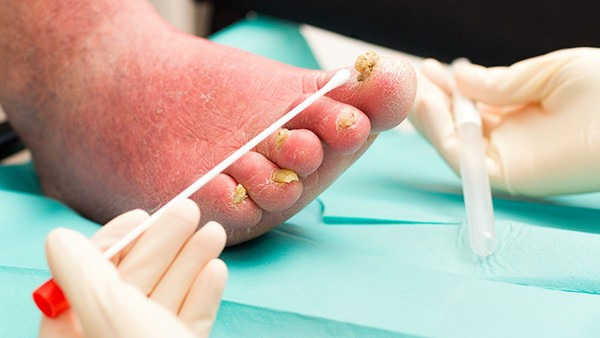 灰指甲怎么治才能除根，灰指甲3个治疗方法及护理措施