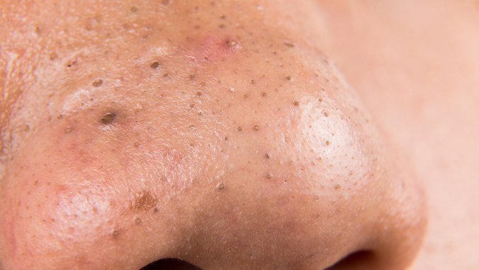 鼻子痤疮的原因是什么？螨虫感染