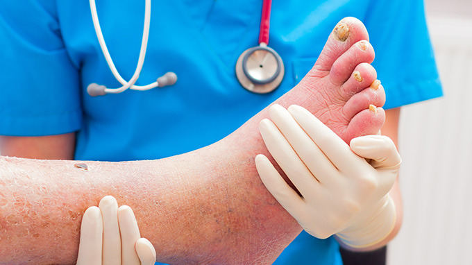 患有脚气该怎么进行根治 治疗脚气的偏方都有哪些