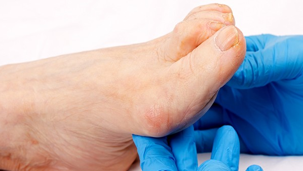 脚脱皮是怎么回事 诱发脚蜕皮的病因都有哪些