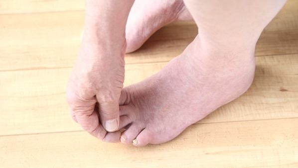 脚脱皮该怎么办才好 治疗脚蜕皮的偏方都有哪些