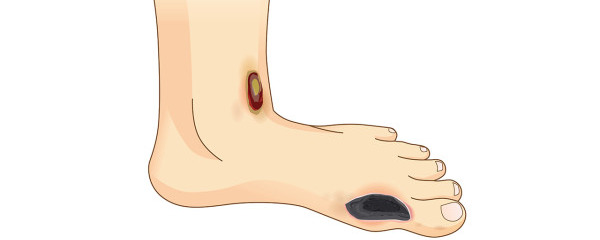 脚上起水泡痒怎么进行治疗 脚上起水泡痒常见的治疗方法都有哪些