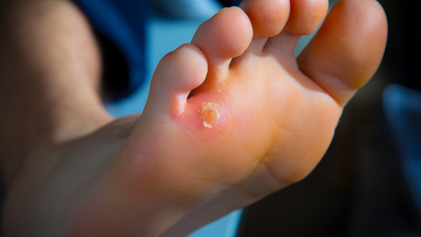脚气灰指甲该怎么进行根治 脚气灰指甲常见的治疗方法都有哪些