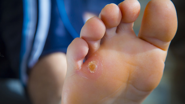 艾葉泡腳的功效和作用是什么 艾葉泡腳能祛除腳氣嗎