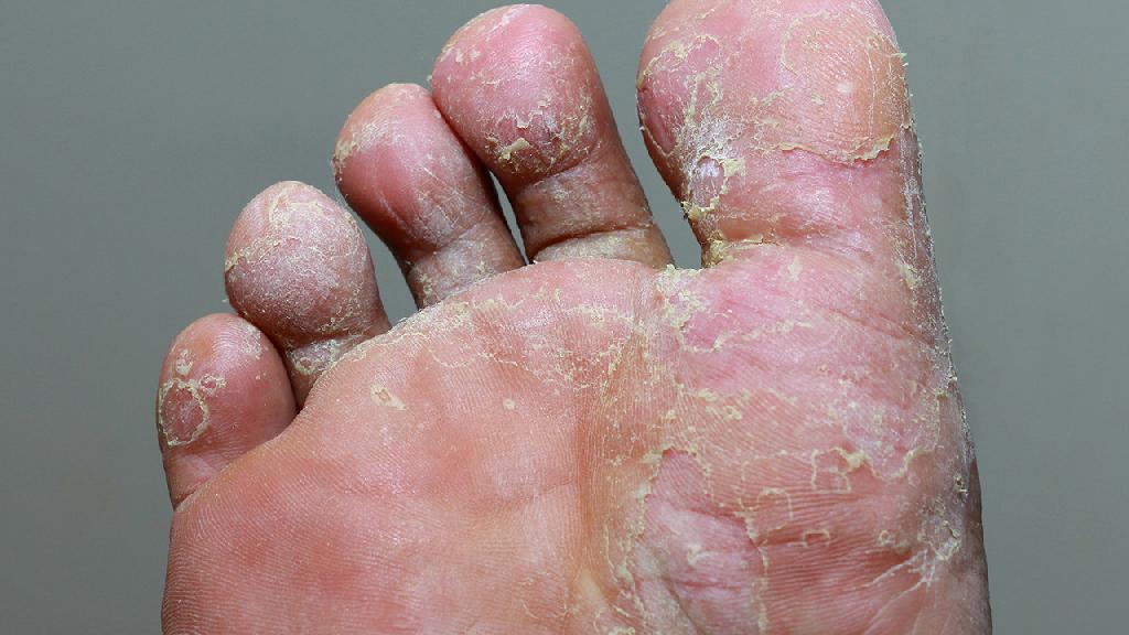 脚底脱皮脚气该怎么治疗 用花椒水能治疗脚底脱皮脚气吗