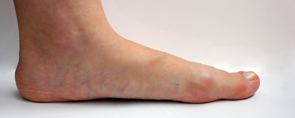 脚皮厚是什么原因导致的 如何才能缓解脚皮厚的症状表现