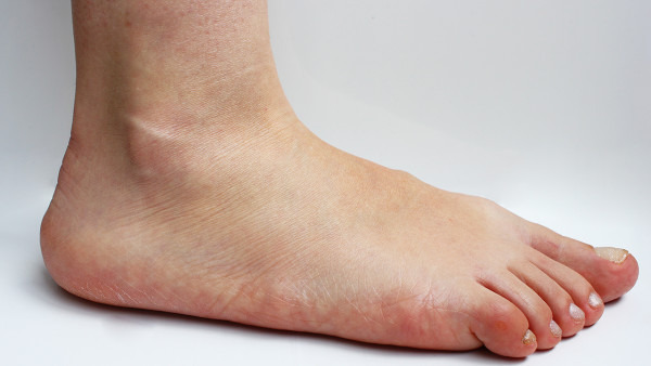 脚干脚裂是什么原因导致的 脚干脚裂会受天气因素影响吗