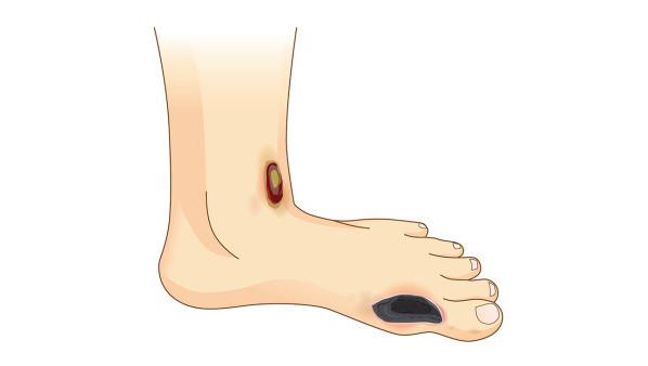糜烂型脚气该怎么治 糜烂型脚气的常见病因都有哪些