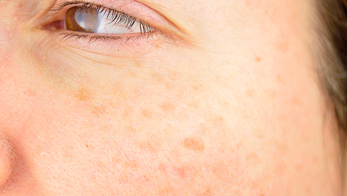 脸部皮肤过敏吃什么药好 皮肤过敏常用的5种药