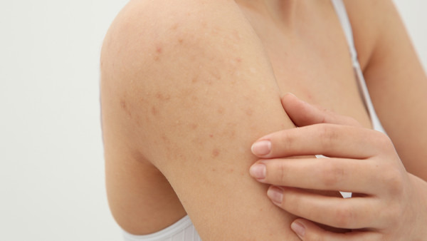 皮肤容易过敏是什么原因导致的 皮肤过敏的症状