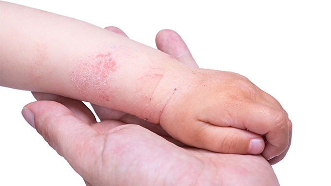 宝宝皮肤过敏怎么办 常用的6种处理方法