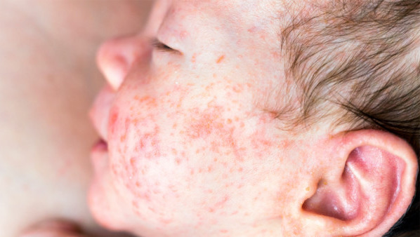 孩子皮肤过敏怎么办，孩子皮肤过敏的原因是什么？