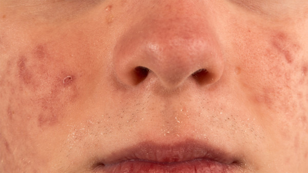 脸上过敏瘙痒怎么办 治疗方法有四种