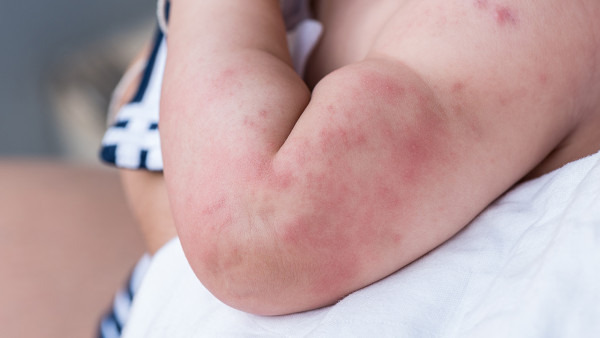 宝宝过敏性皮炎多久好，过敏性皮炎什么症状？
