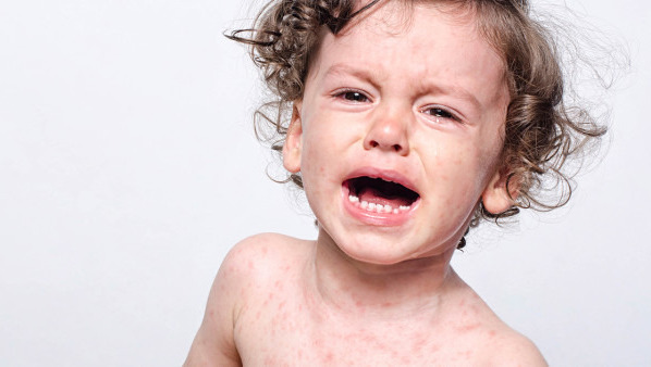 三岁宝宝过敏性皮炎怎么办，有哪些注意事项？