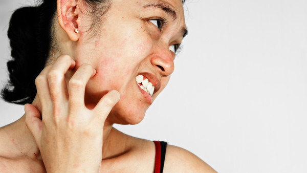 脸上皮炎多久才能恢复，影响脸上皮炎恢复的因素是什么？