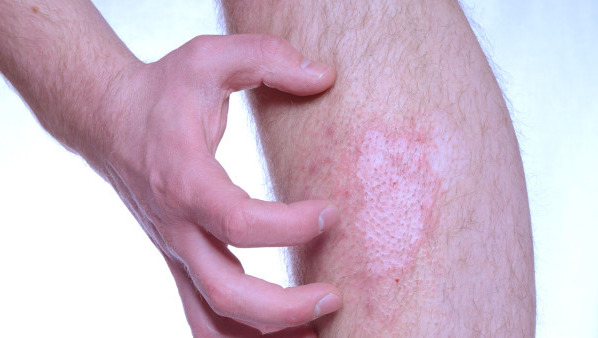 疤痕体质如何消除，有什么去除疤痕的办法？