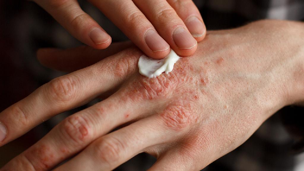 湿疹性皮炎多久能治愈，湿疹性皮炎如何治疗？