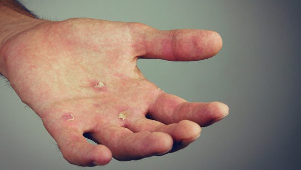 手指脱皮是什么原因？有这5大原因