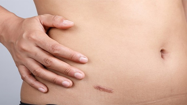 剖腹产后疤痕增生怎么办？有这些治疗方法