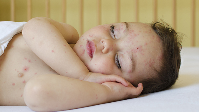 宝宝湿疹能用艾叶进行治疗吗 宝宝湿疹使用艾叶有什么需要注意的事项