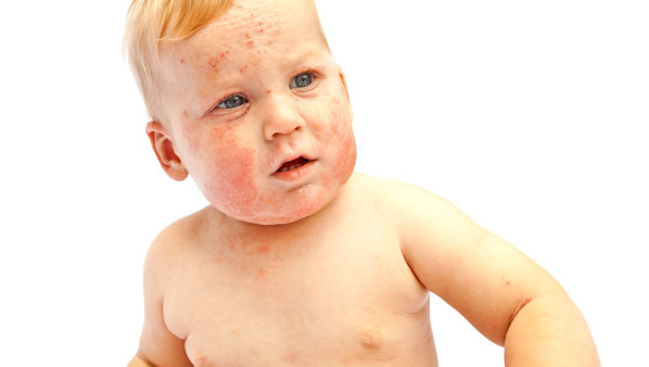 宝宝头上长湿疹怎么办 宝宝头上长湿疹该如何进行调理